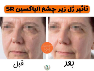 فیلر زیر چشم الیاکسین قیمت