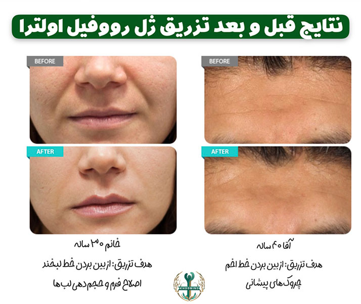 قیمت ژل لب رووفیل اولترا
