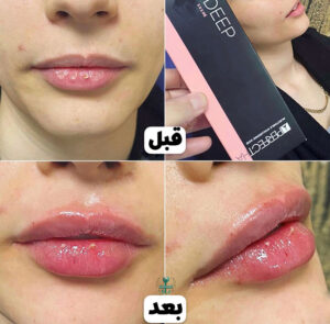 قیمت ژل لب پرفکتا
