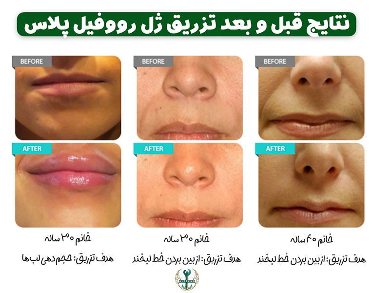 قیمت ژل لب Revofil Plus