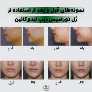 قیمت نورامیس دیپ لیدو