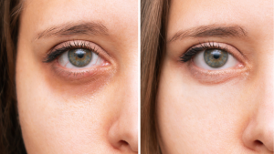 مزوژل جالپرو یانگ آی حجم 1 سی سی (young eye)