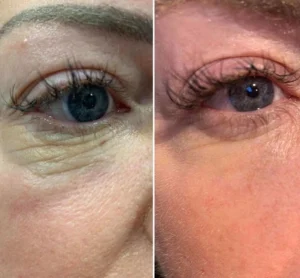 مزوژل جالپرو یانگ آی حجم 1 سی سی (young eye)